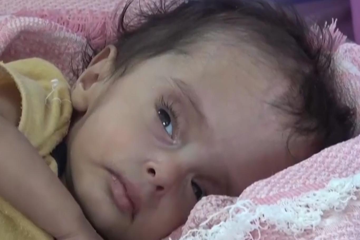 Yemen'deki savaştan en çok çocuklar etkileniyor